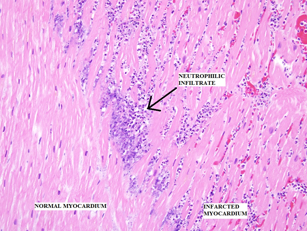 Myocardial Infarction Cardiovascular Medbullets Step 1