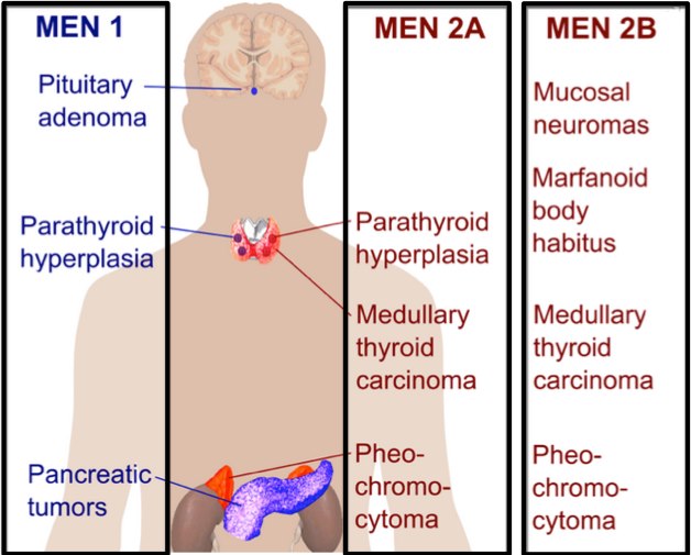 Multiple Endocrine Neoplasias - Endocrine - Orthobullets