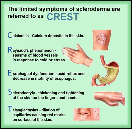 Scleroderma - Rheumatology - Medbullets Step 2/3