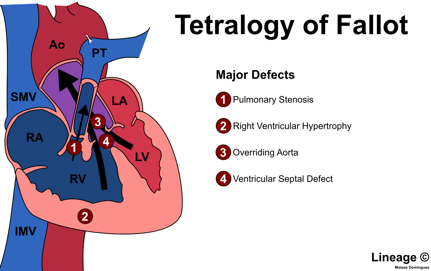 Tetralogy Of Fallot Tof Is A Congenital