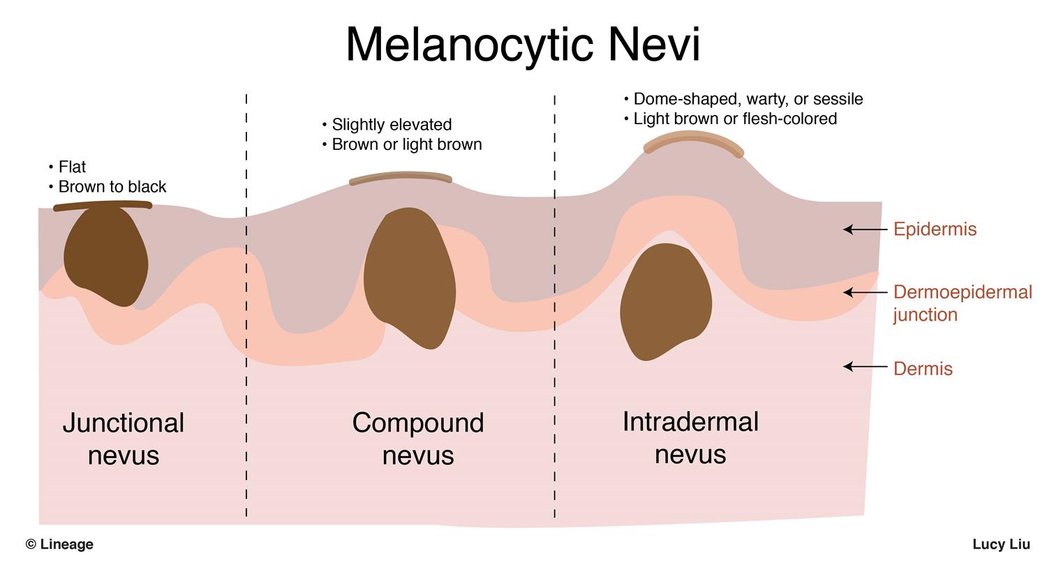 junctional melanocytic nevus