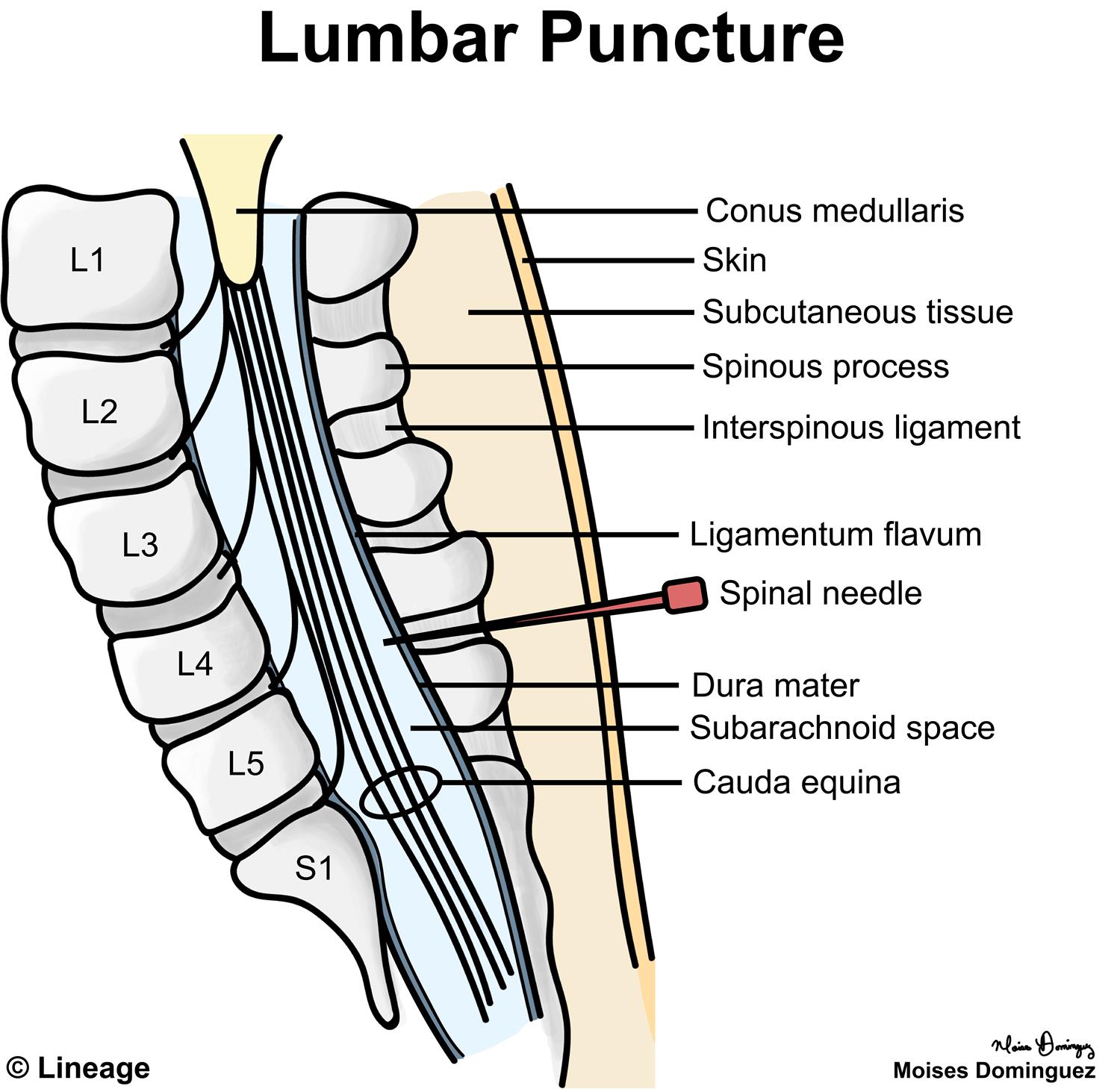 Lumbar Puncture Neurology Medbullets Step 1