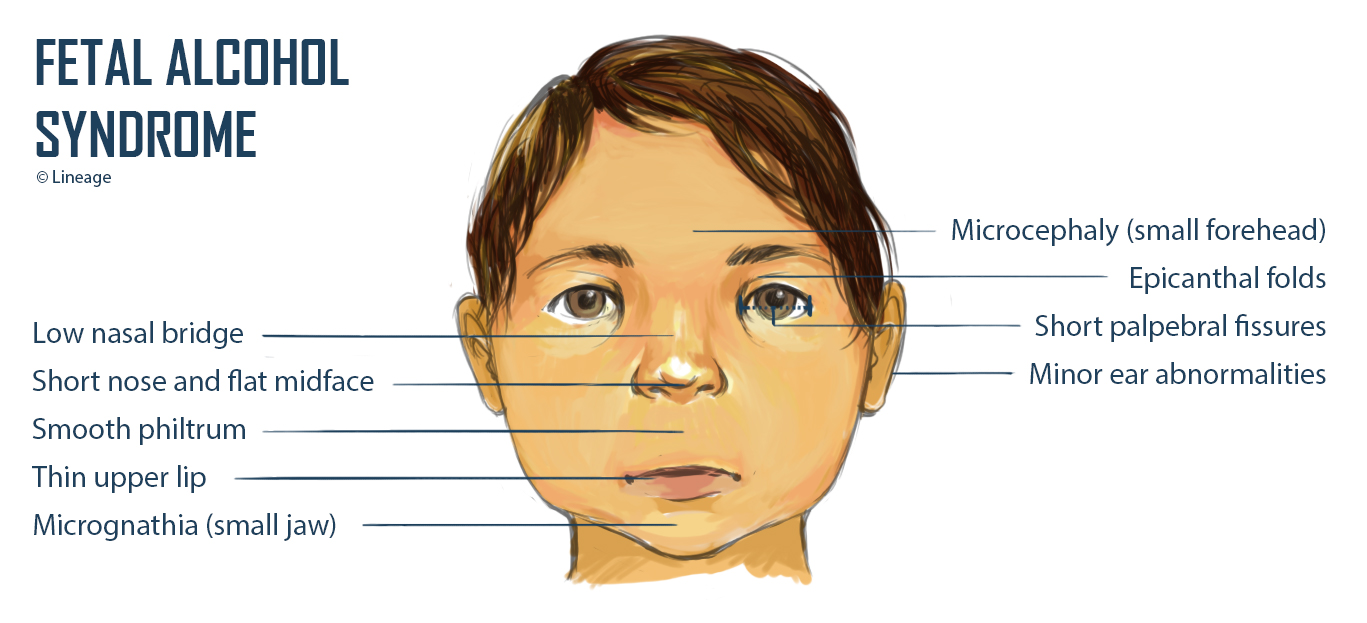 Alcohol symptoms syndrome fetal of Fetal alcohol