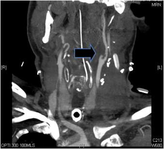 Carotid Dissection Cardiovascular Medbullets Step Vrogue Co