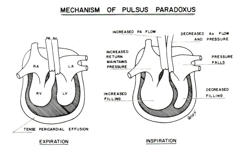 Cardiac Tamponade Cardiovascular Medbullets Step 1
