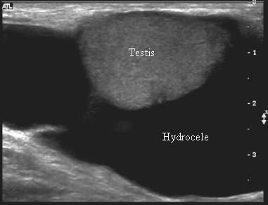 Hydrocele Reproductive Medbullets Step 1