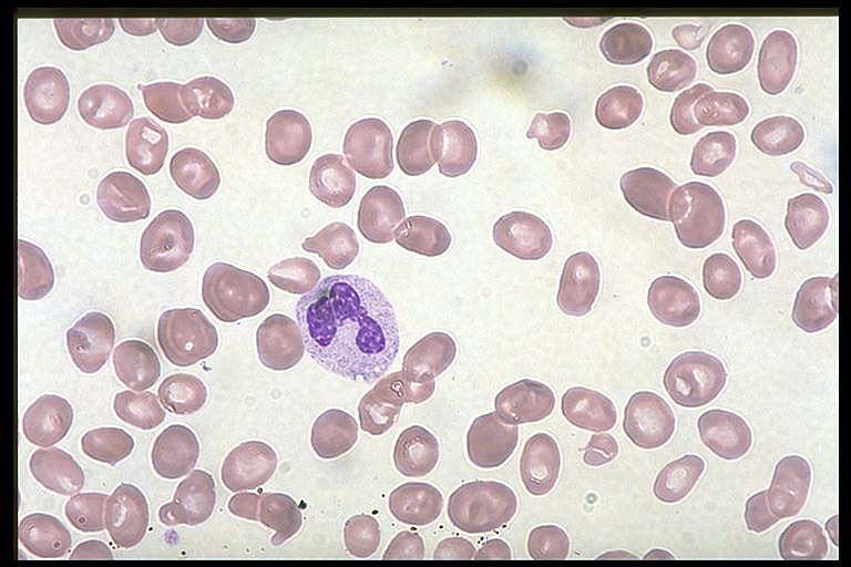 Folic Acid Deficiency Heme Medbullets Step 2/3
