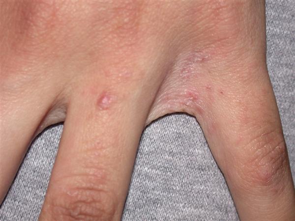 Scabies Rash Between Fingers