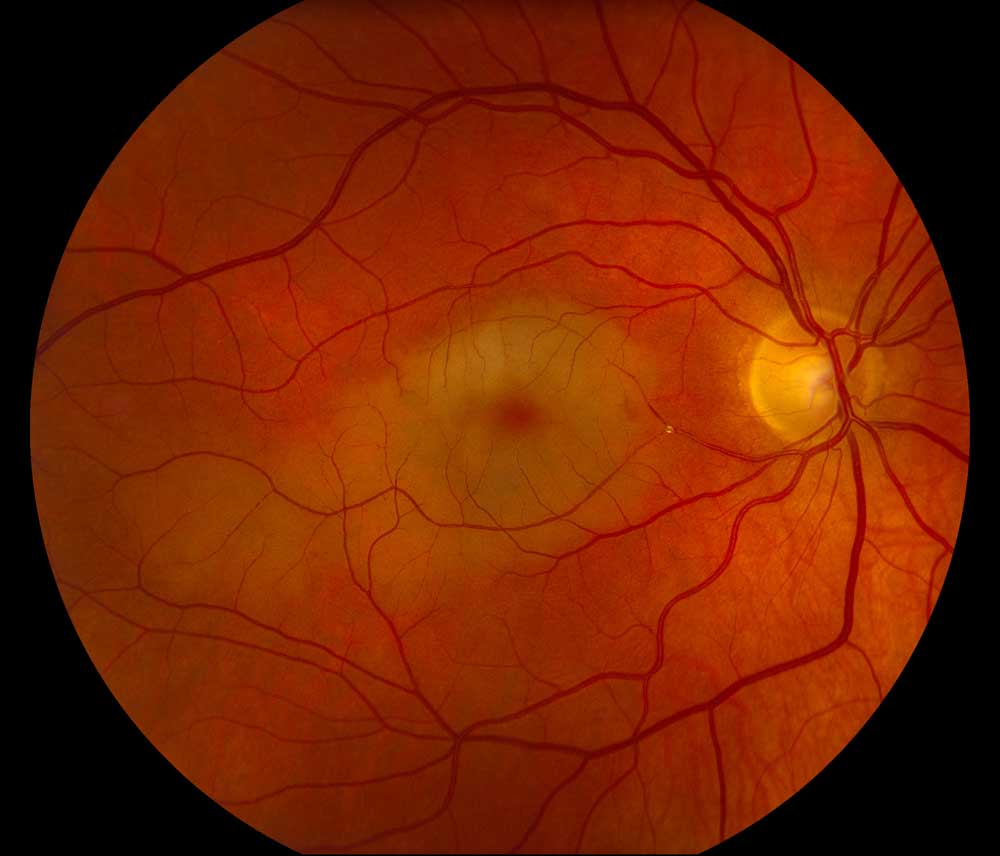 Retinal Artery Occlusion / Amaurosis Fugax - Ophthalmology ... vein diagram with 3 