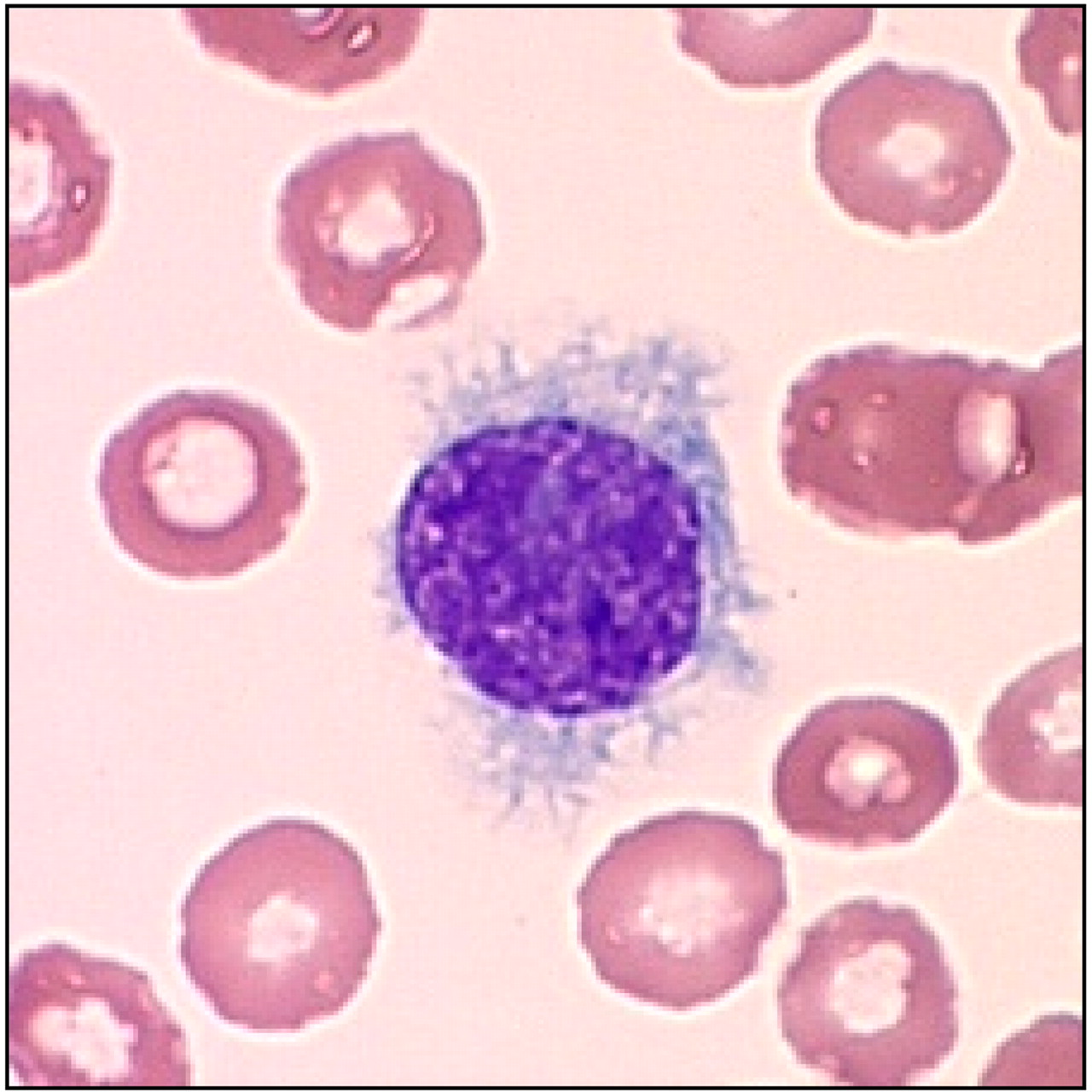 Hairy Cell Leukemia (HCL) - Oncology - Medbullets Step 1