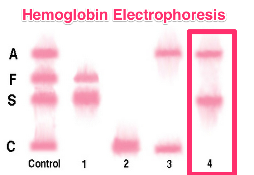 Sickle Cell Anemia Heme Medbullets Step 2/3