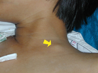 Gastric Cancer - Oncology - Medbullets Step 2/3