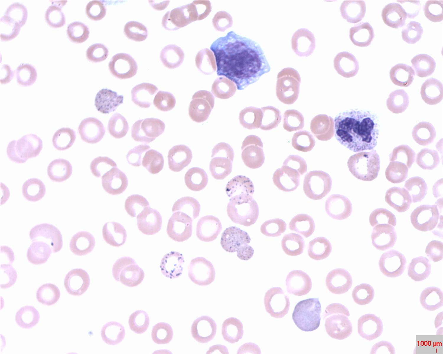 Lead Poisoning Heme Medbullets Step 2/3