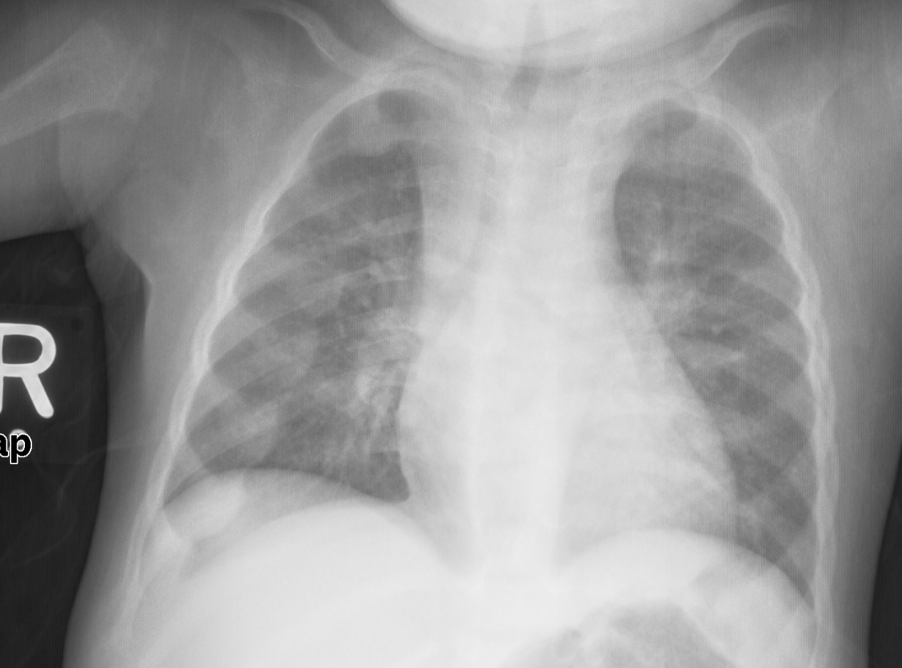 Vitamin D Nutrition Medbullets Step 2/3