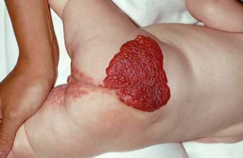 infantile hemangioma dermatology medbullets step 2 3