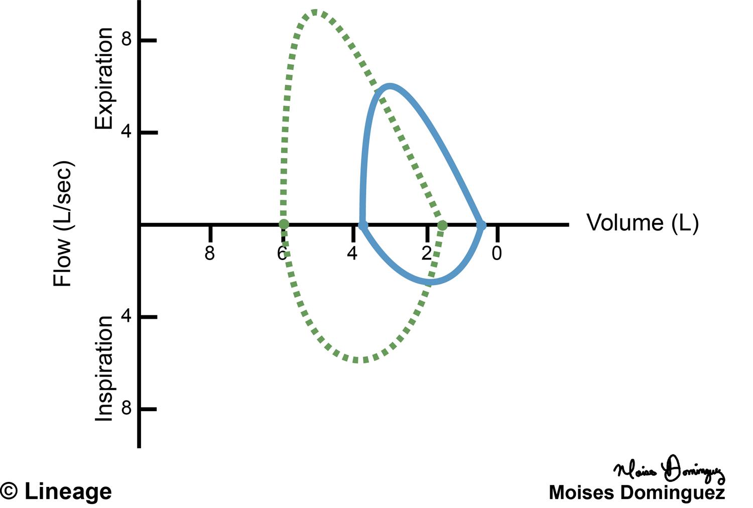 Interstitial Lung Disease - Pulmonary - Medbullets Step 2/3