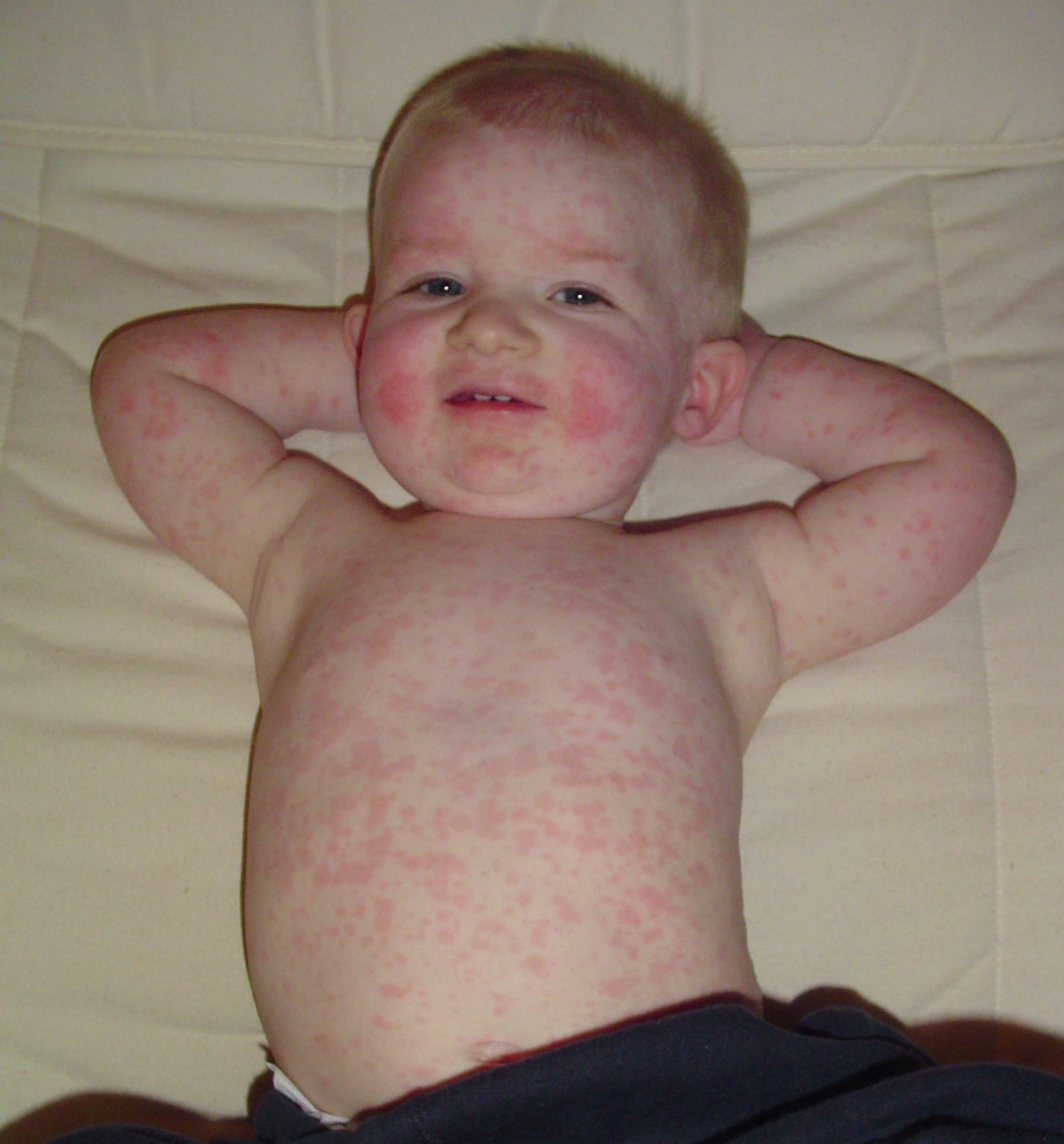 Parvovirus B19 USMLE Strike