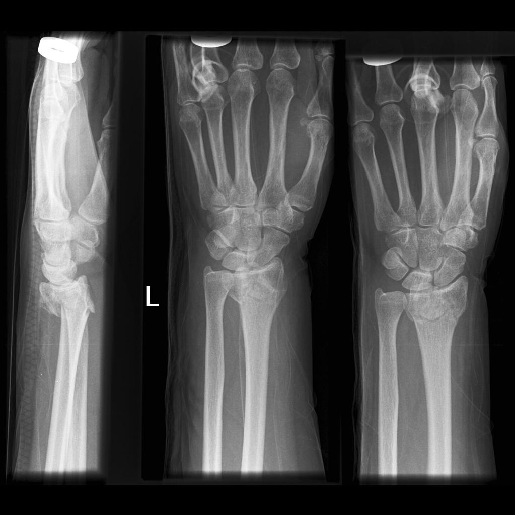 Fracturas Del Radio Distal Manejo De Fracturas De Radio Distal En 