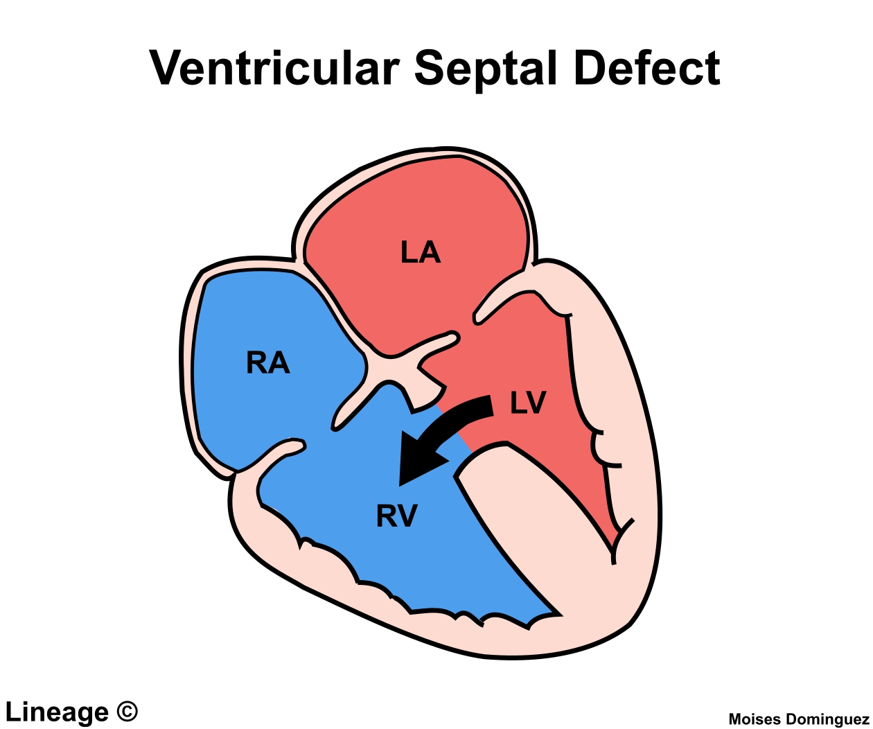 Ventricular Septal Defect In A Child With Alport Syndrome