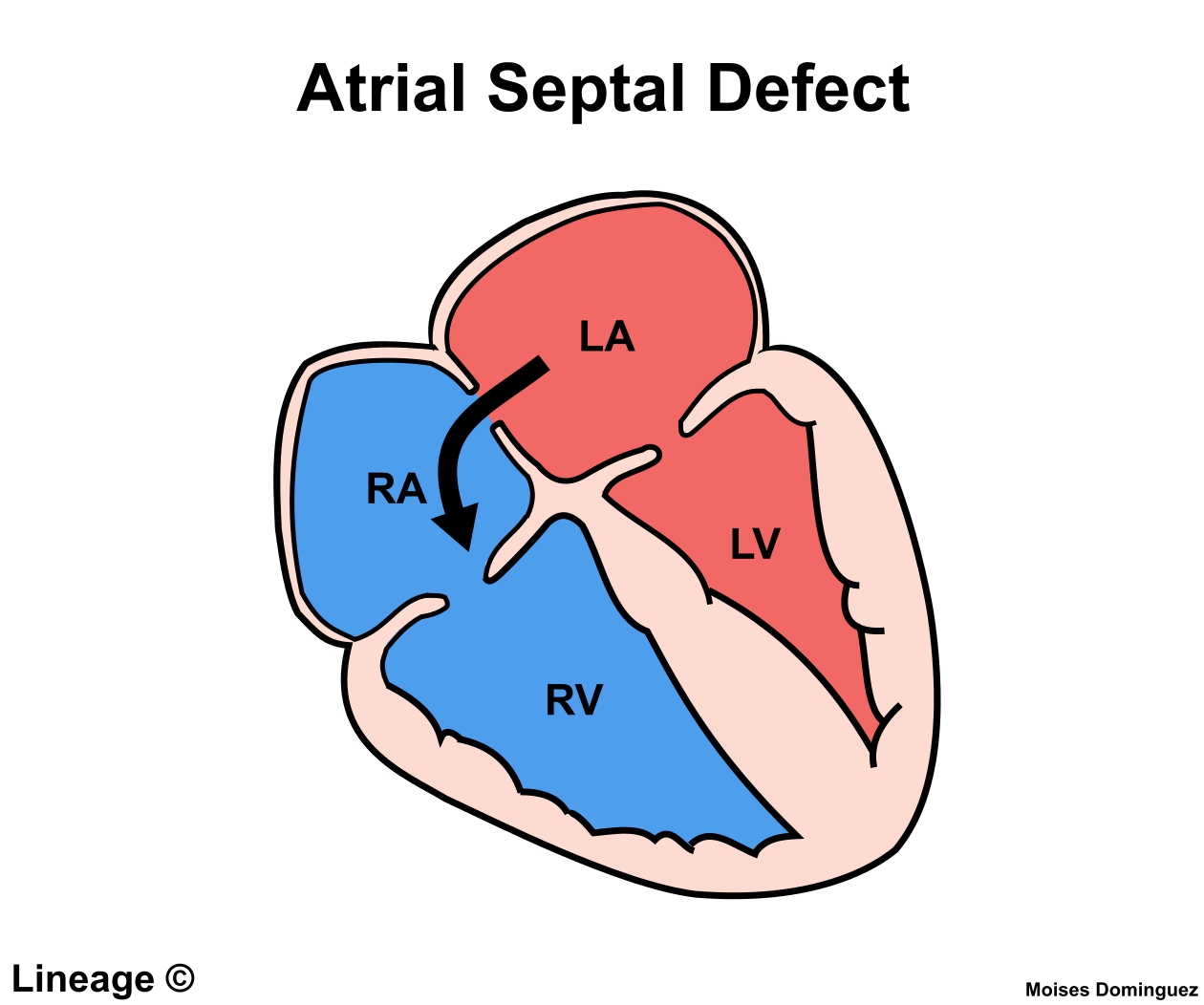 Primum atrial septal defect