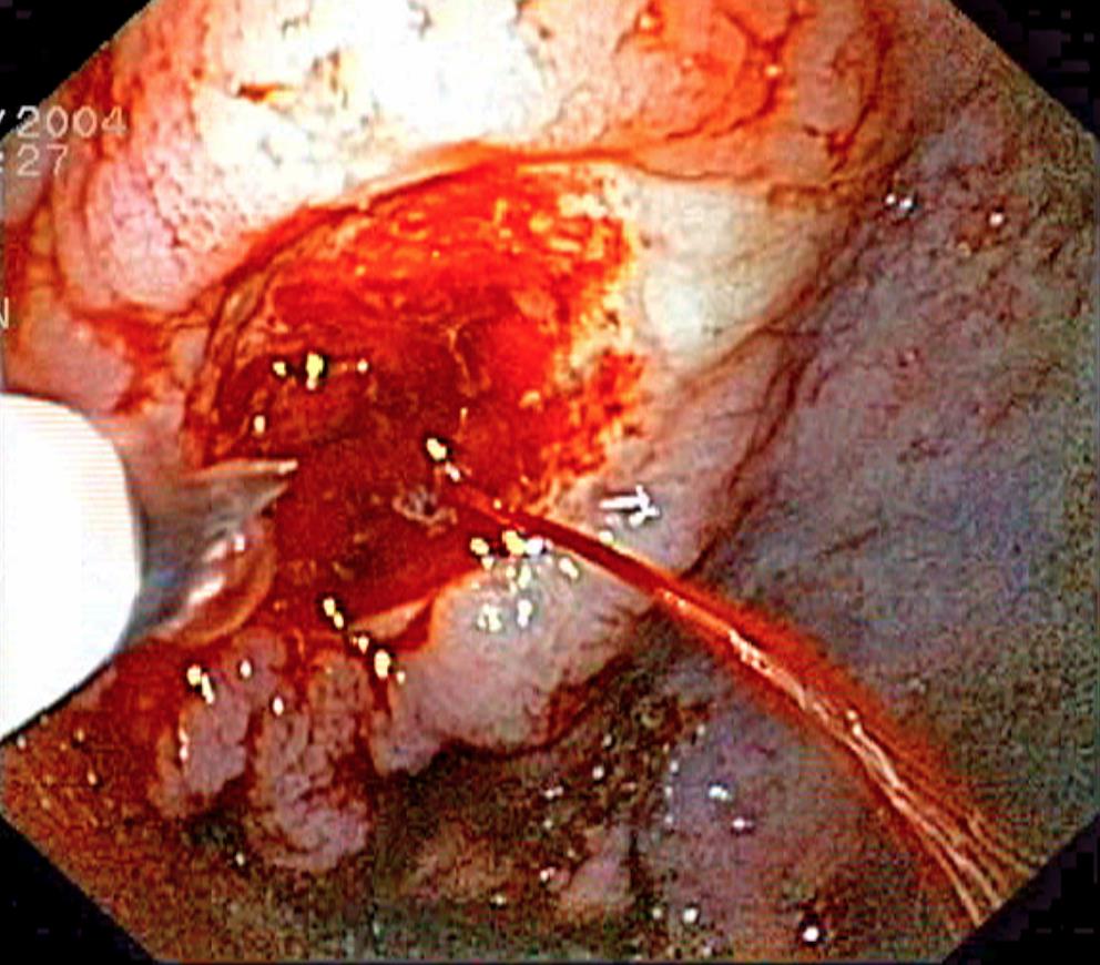 Upper GI Bleed Gastrointestinal Medbullets Step 1