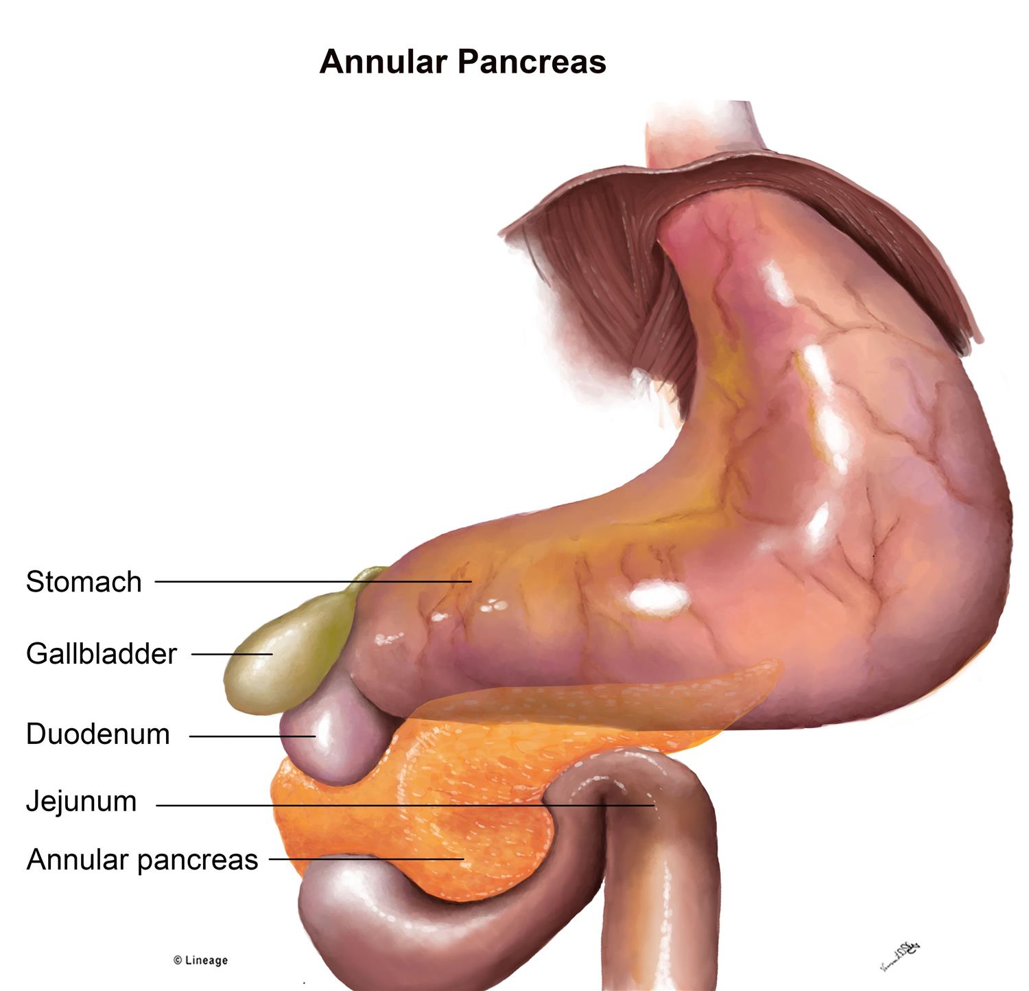 annular pancreas embryology