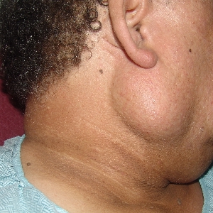 submandibular tumor