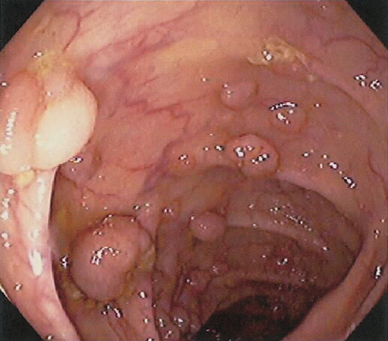 tubulovillous adenoma with dysplasia