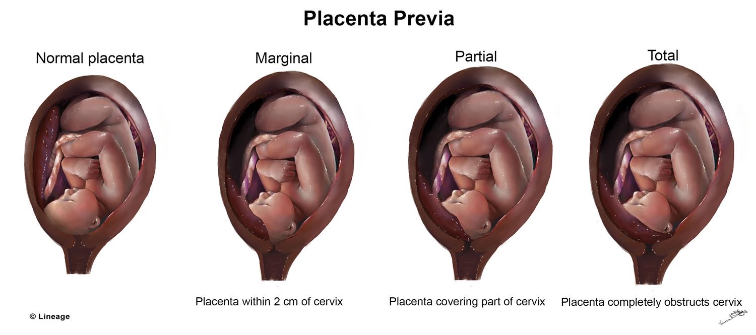 Classification Of Placenta Previa