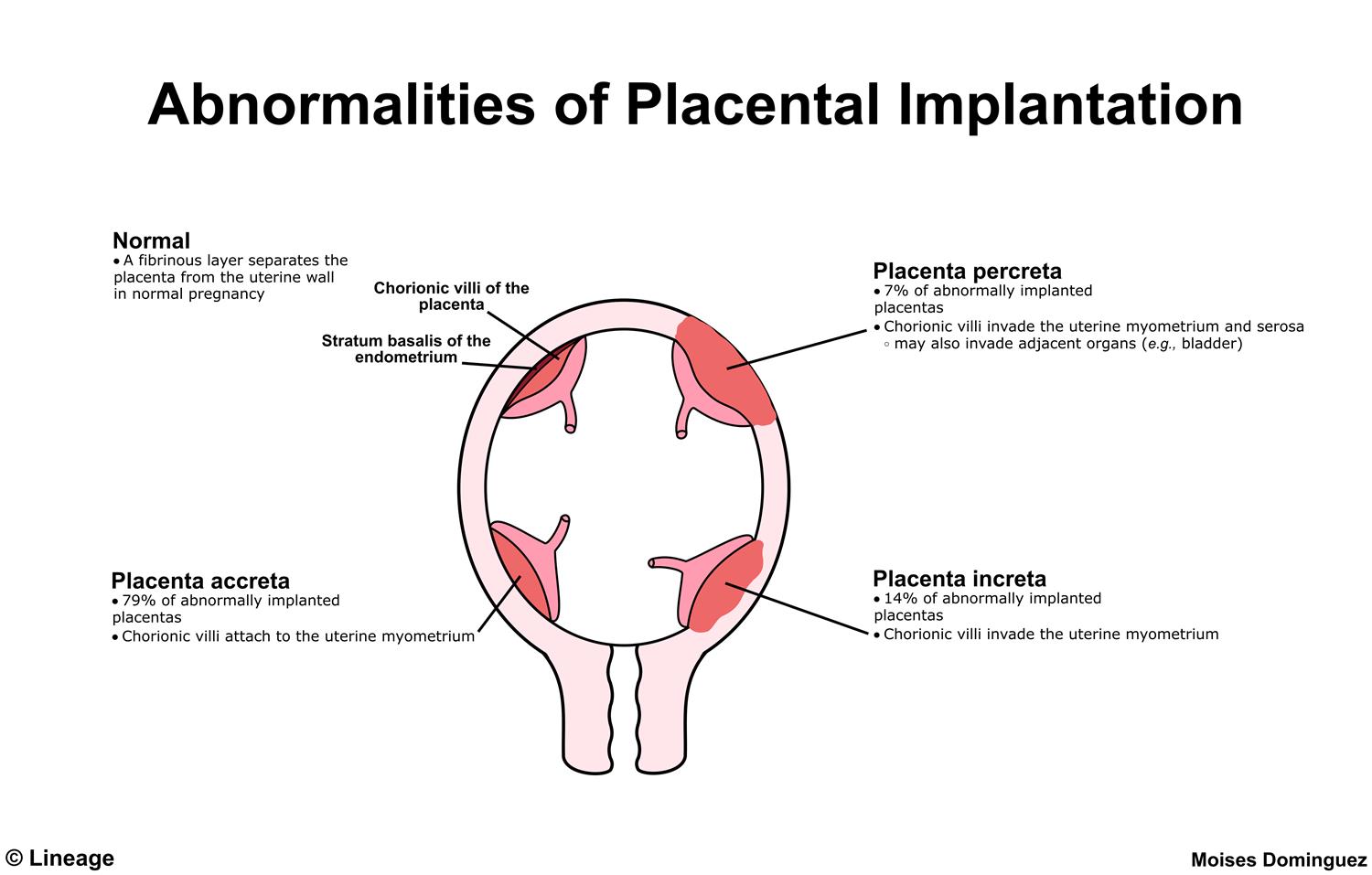 Placenta Accreta - Reproductive - Medbullets Step 1