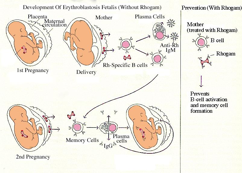 Rh Hemolytic Disease of the Newborn Hematology 