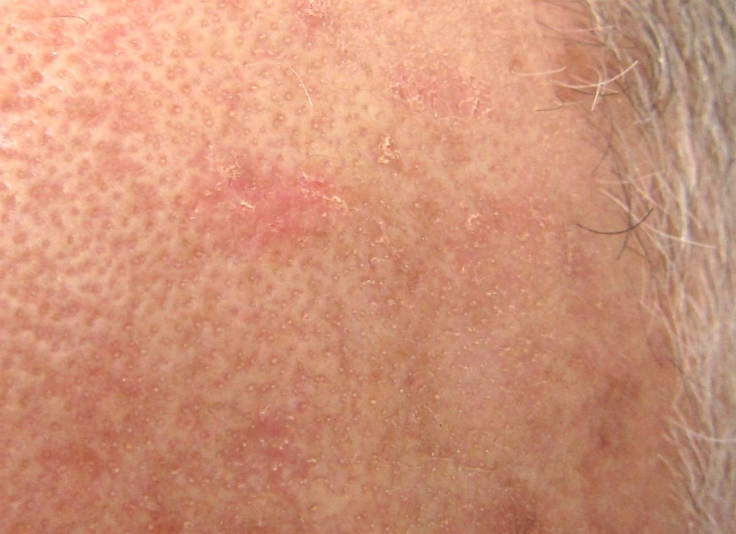 Actinic Keratosis Dermatology Medbullets Step 1