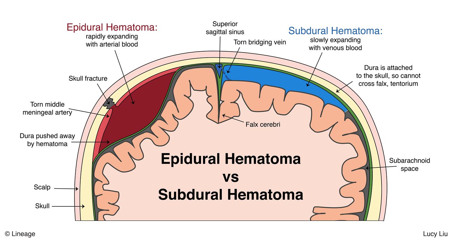 intracranial-hemorrhage-neurology-medbullets-step-1