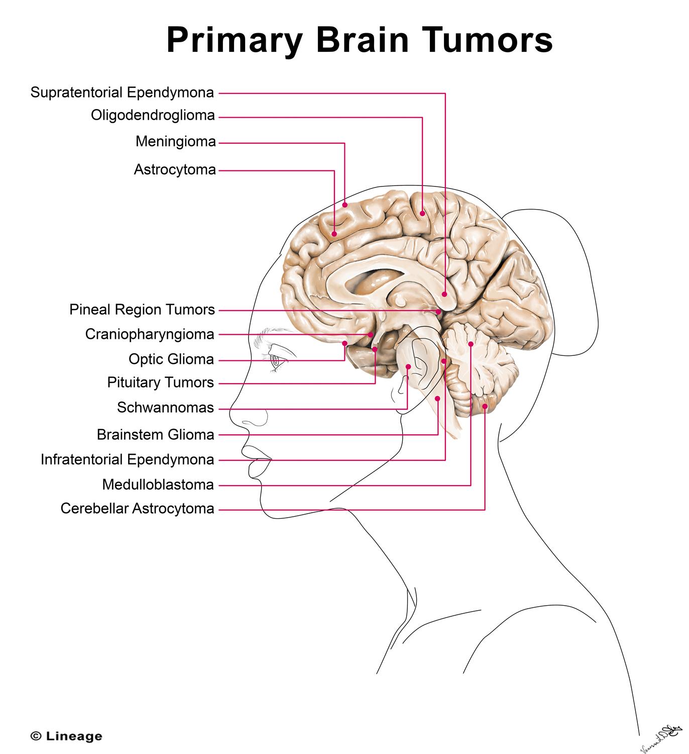 Brain Tumor Size Chart Mm