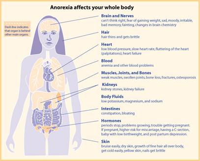 https://upload.medbullets.com/topic/114039/images/anorexia.jpg