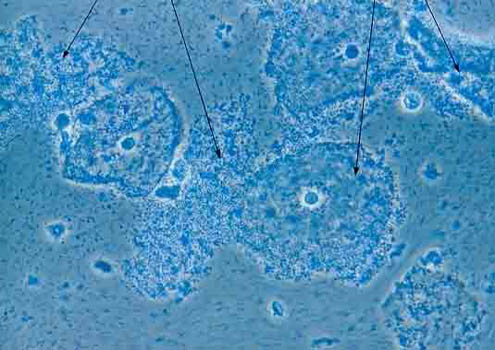 trichomonads and clue cells