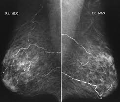 fibrocystic breast changes and brest cancer