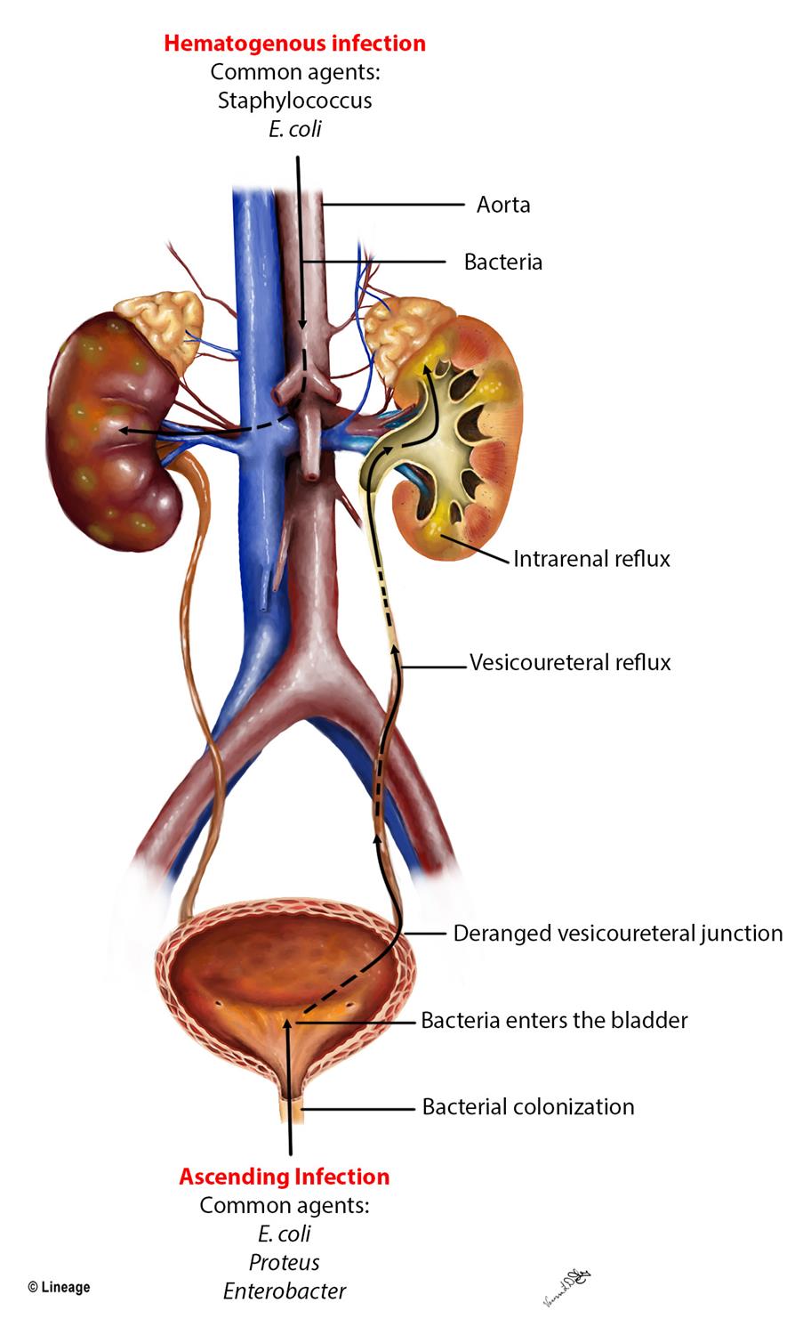 urinary tract infection pathophysiology diagram