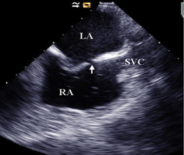 Atrial Septal Defect (ASD) - Cardiovascular - Medbullets Step 2/3