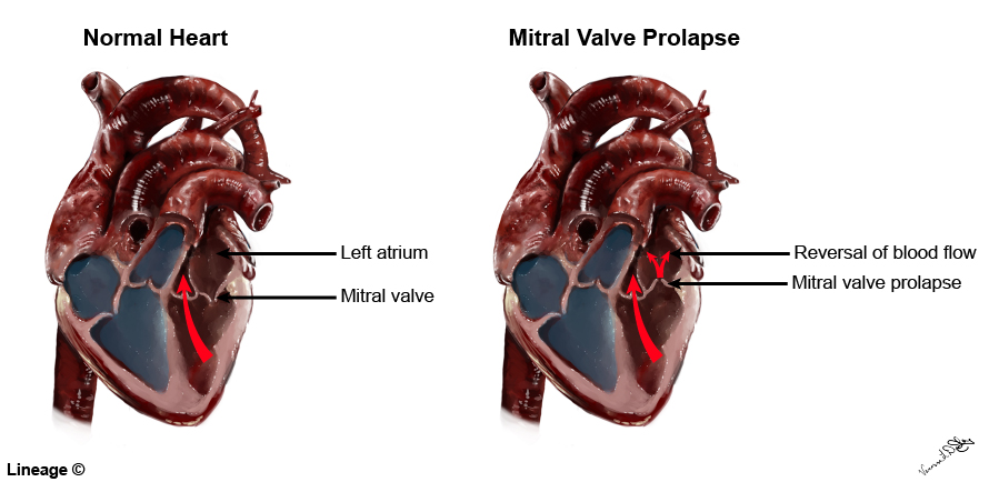Valvular Disease USMLE Strike