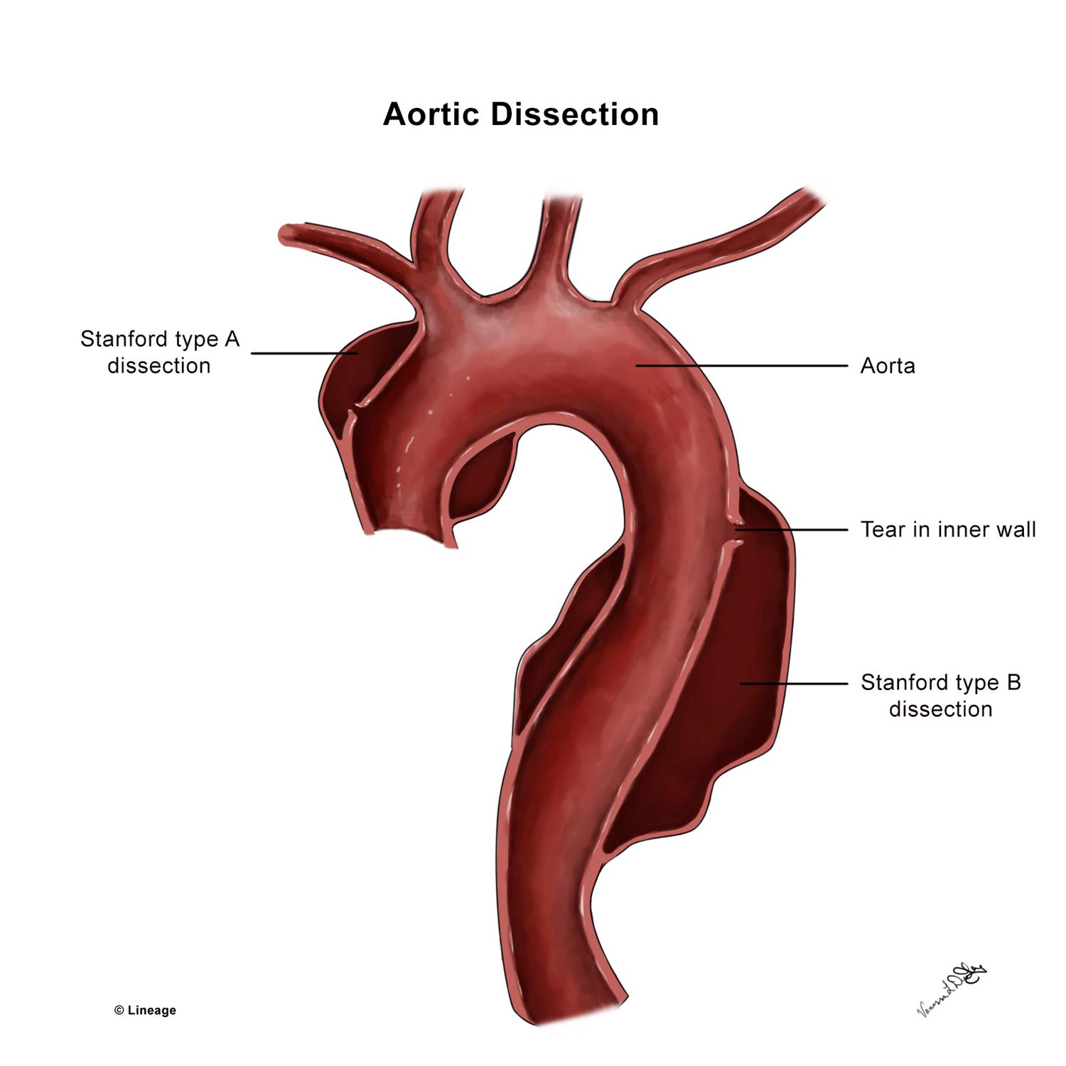 Aortic Dissection Cardiovascular Medbullets Step 2 3