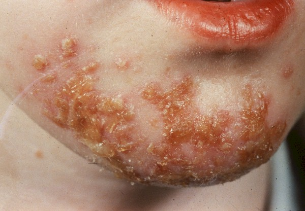 impetigo on chin