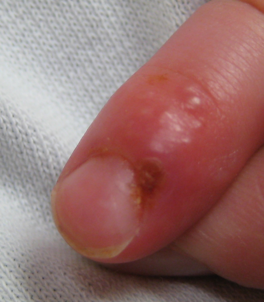 Herpes Simplex Dermatology Medbullets Step 2 3