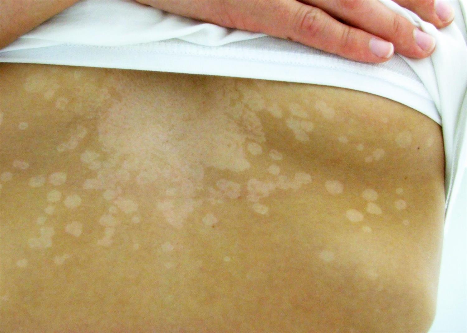 Tinea Versicolor Dermatology Medbullets Step 2 3
