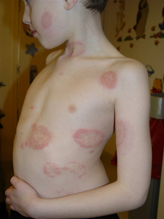 Tinea corporis (Waist and inframammary area).