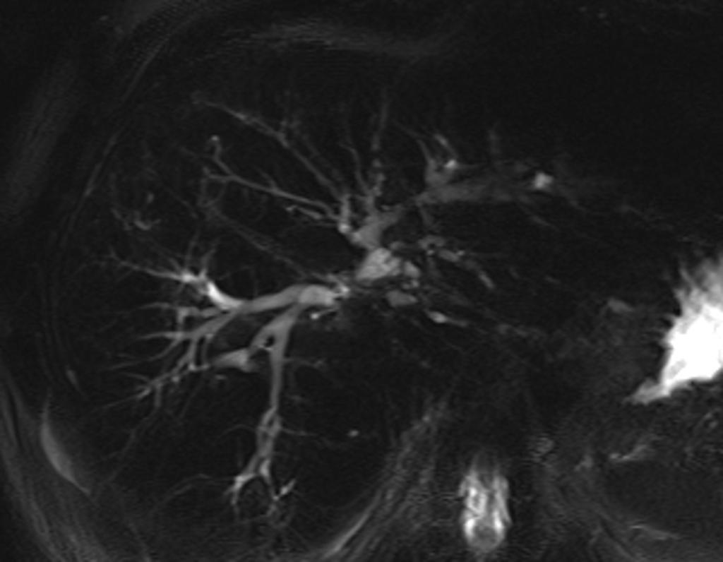 sclerosing cholangitis