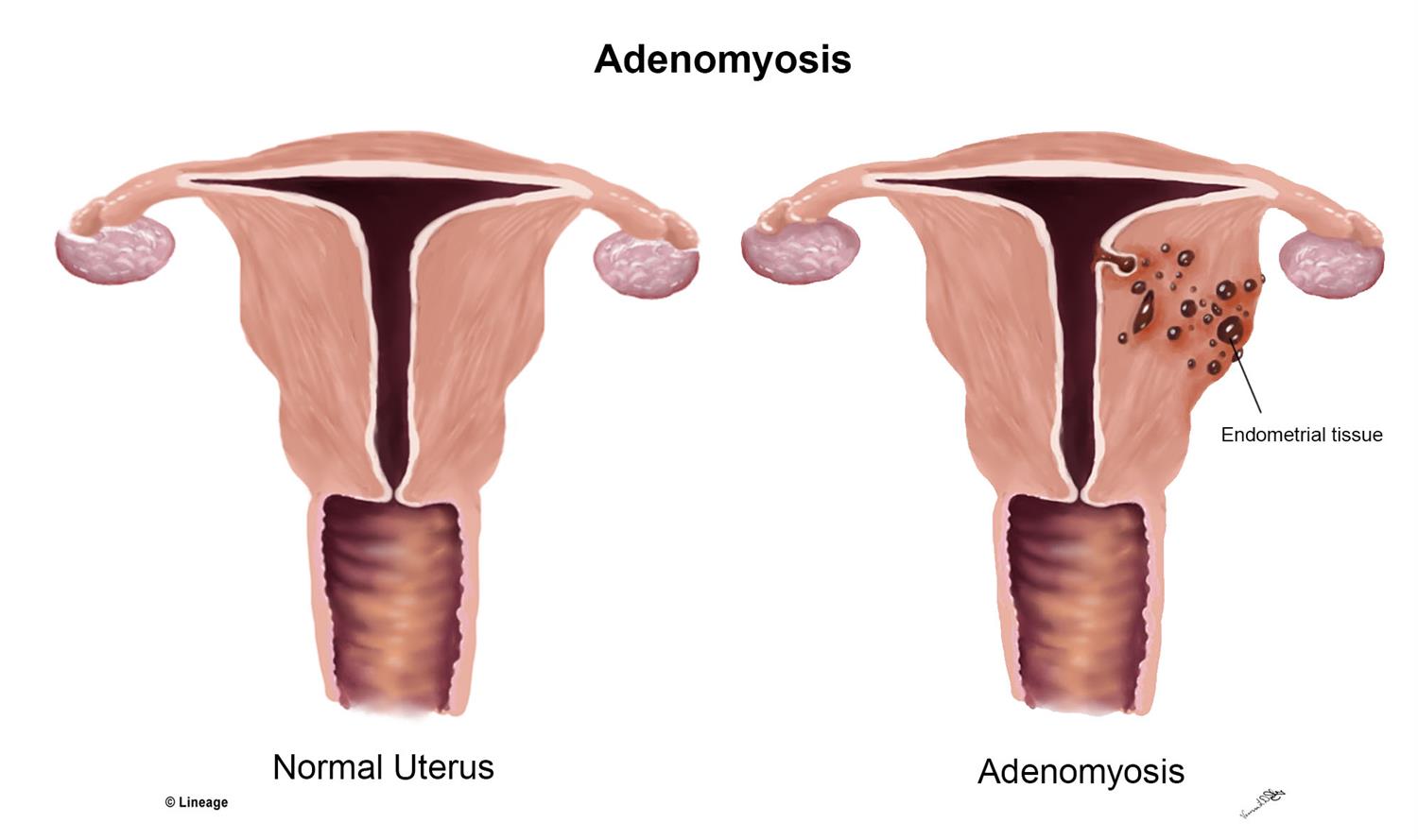 Utero adenomiosis