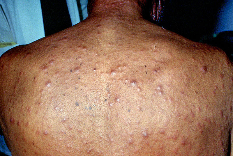 rhagades syphilis