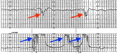 reactive fetal heart rate tracing