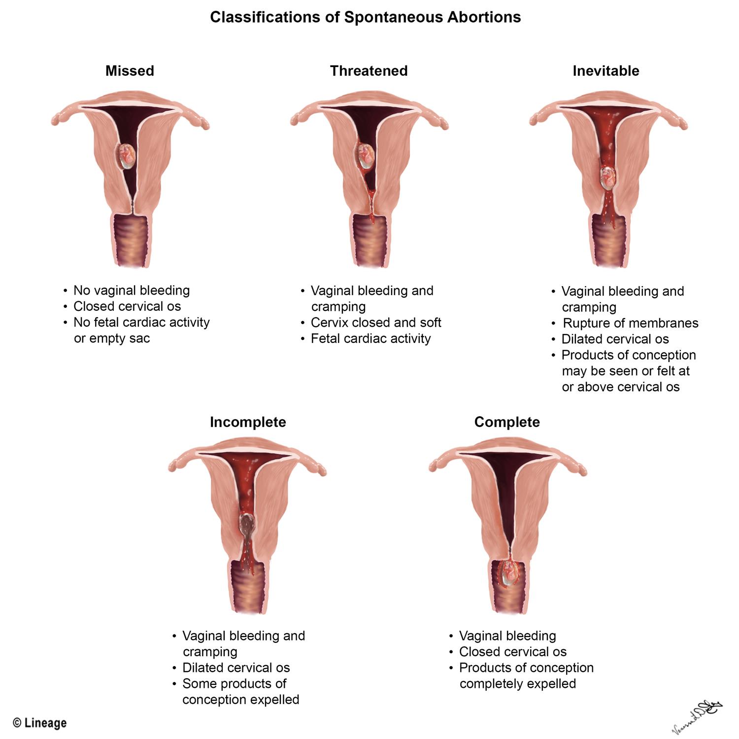 Spontaneous Abortion Obstetrics Medbullets Step 2 3